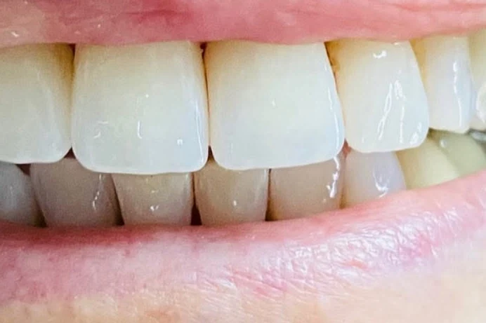 After smile transformation treatment at SmilePro Dental, Dearborn Heights MI
