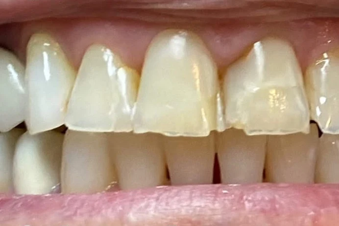 Before smile transformation treatment at SmilePro Dental, Dearborn Heights MI