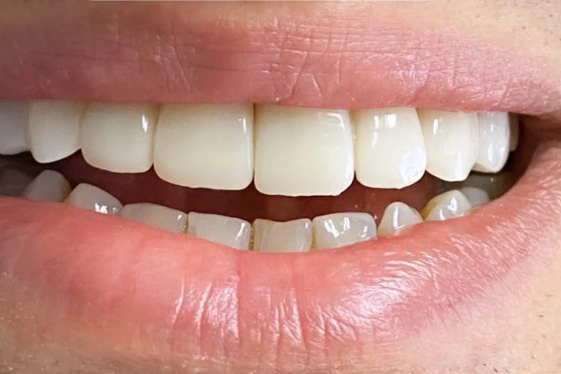 After smile transformation treatment at SmilePro Dental, Dearborn Heights MI