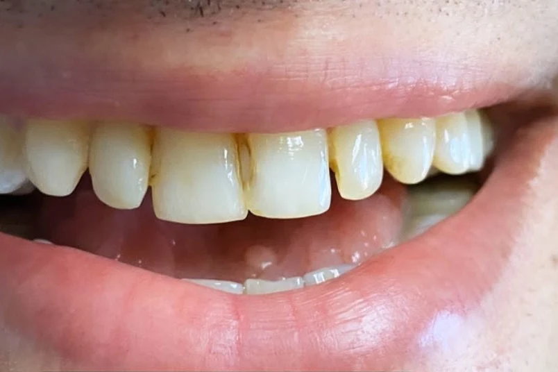 Before smile transformation treatment at SmilePro Dental, Dearborn Heights MI