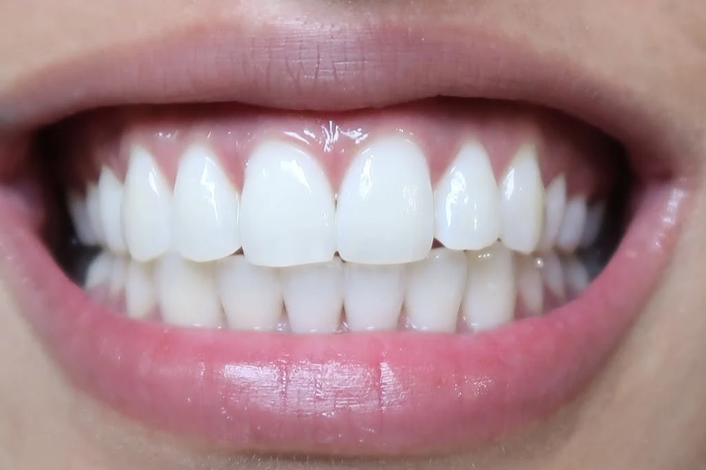 After smile transformation treatment at SmilePro Dental, Dearborn Heights MI