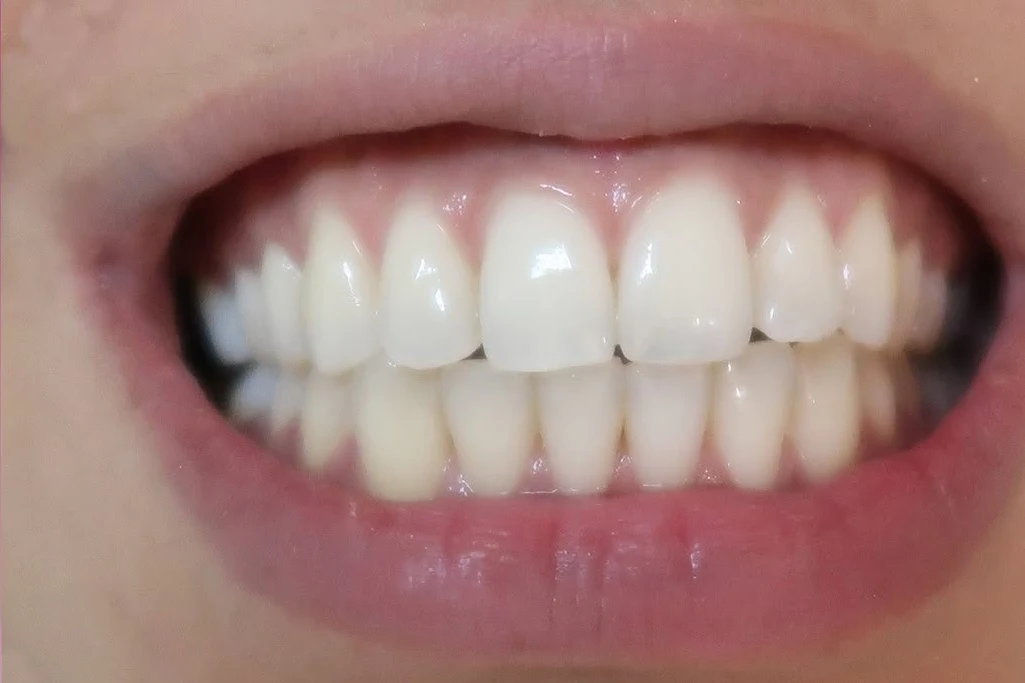 Before smile transformation treatment at SmilePro Dental, Dearborn Heights MI
