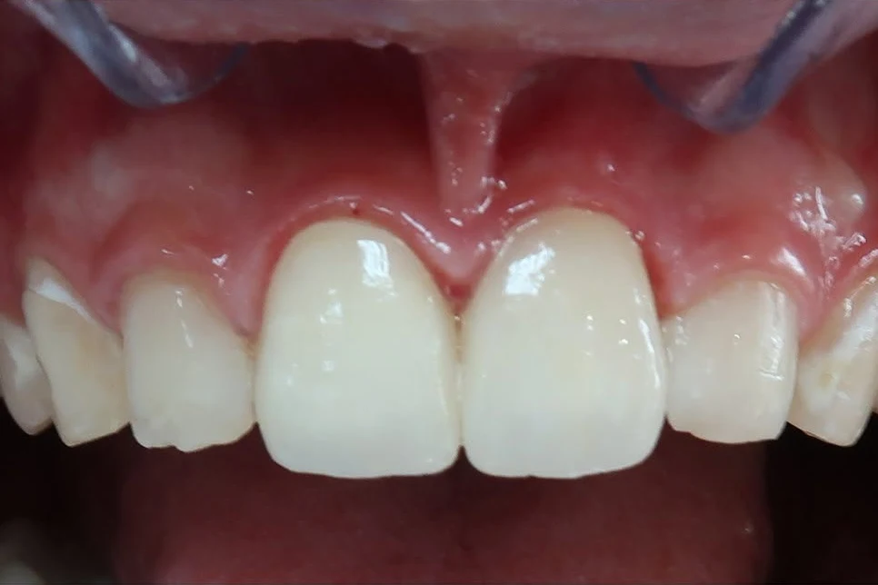 After smile transformation treatment at SmilePro Dental, Dearborn Heights MI