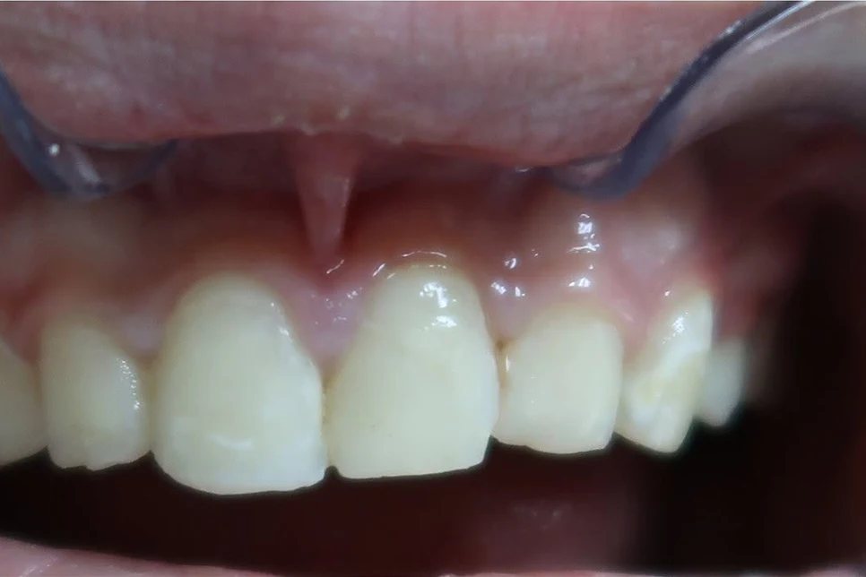 Before smile transformation treatment at SmilePro Dental, Dearborn Heights MI