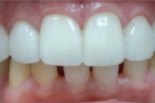 After smile transformation treatment at SmilePro Dental, Dearborn Heights MI