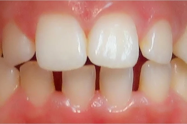 Before smile transformation treatment at SmilePro Dental, Dearborn Heights MI