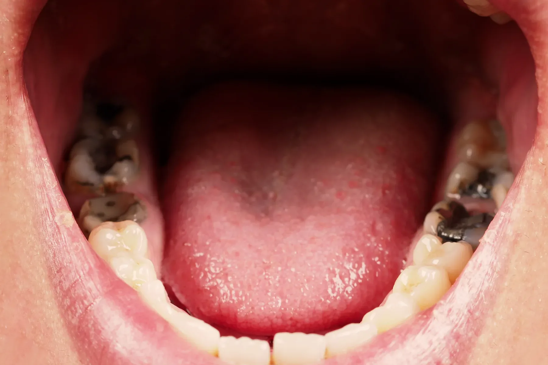 A close-up of back teeth with dark metal fillings